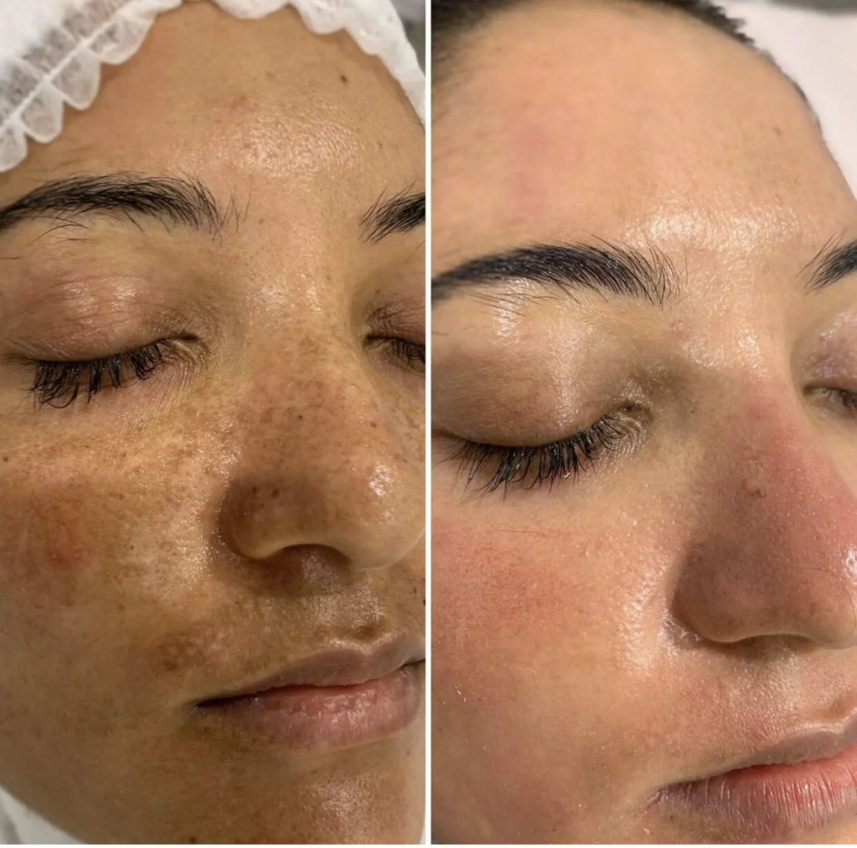 Cosmelan Peel — Verdo Parnell Cosmelan Peel — Verdo Parnell