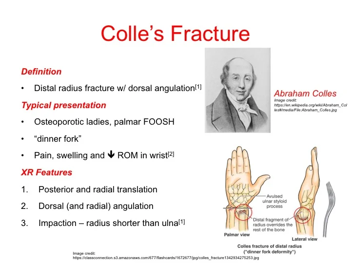 Colles Fracture — learnED