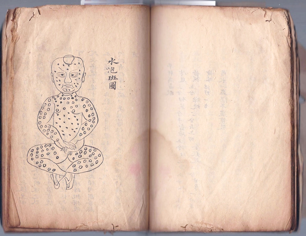 Hand-drawn medical book on rashes and blisters, China, early 20th century.