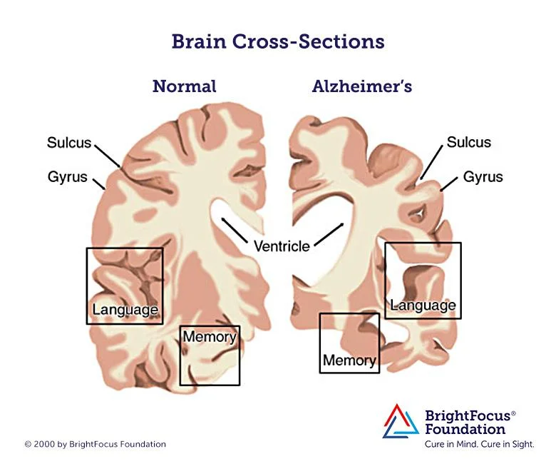 Image courtesy of BrightFocus Foundation .