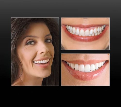 Maria was unhappy with her smile. I performed orthodontic treatment to intrude the maxillary centrals, improving the maxillary gingival excess and provide a more pleasing smile line. After completing the orthodontic treatment, I placed six Macveneers on teeth 6-11. Later, I removed the existing crowns on teeth #3 and 14 and a periodontist placed mucogingival grafts for buccal root coverage due to recession. Finally, we placed new Macstudio Lava™ crowns on these teeth at the correct gingival marginal height. – Maria - 8 Macveneers – Dentistry by Dr. James Schechter