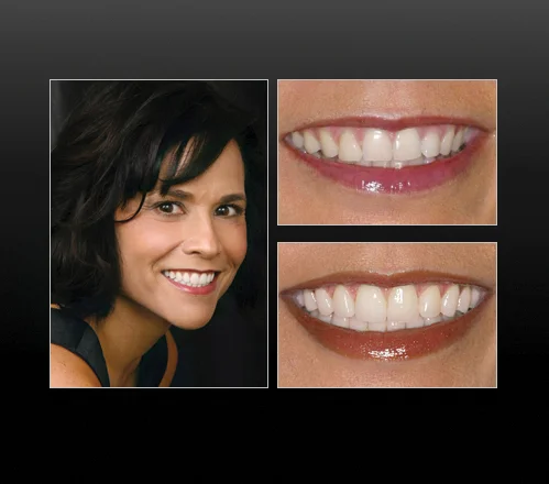 Connie had symptoms that included headaches, neckaches, problems sleeping and problems driving her car. She chose full mouth rehabilitation for her long-term maintenance. We transferred the bite and restored all 28 teeth with Empress restorations. We finished this case in June of 2003 and Connie has remained symptom free ever since, as well as enjoying her beautiful smile. – Dentistry by Dr. Michael Reece After treatment from Dr. Reece, I no longer have any of the head, neck or ear symptoms I used to have. Overall, I would consider my treatment a great success, and I get a great smile to go with it. – Connie - 28 Macveneers 