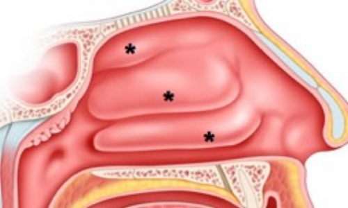 Sinus Specialist | Melbourne | Philip Michael ENT Surgeon | Nose ...