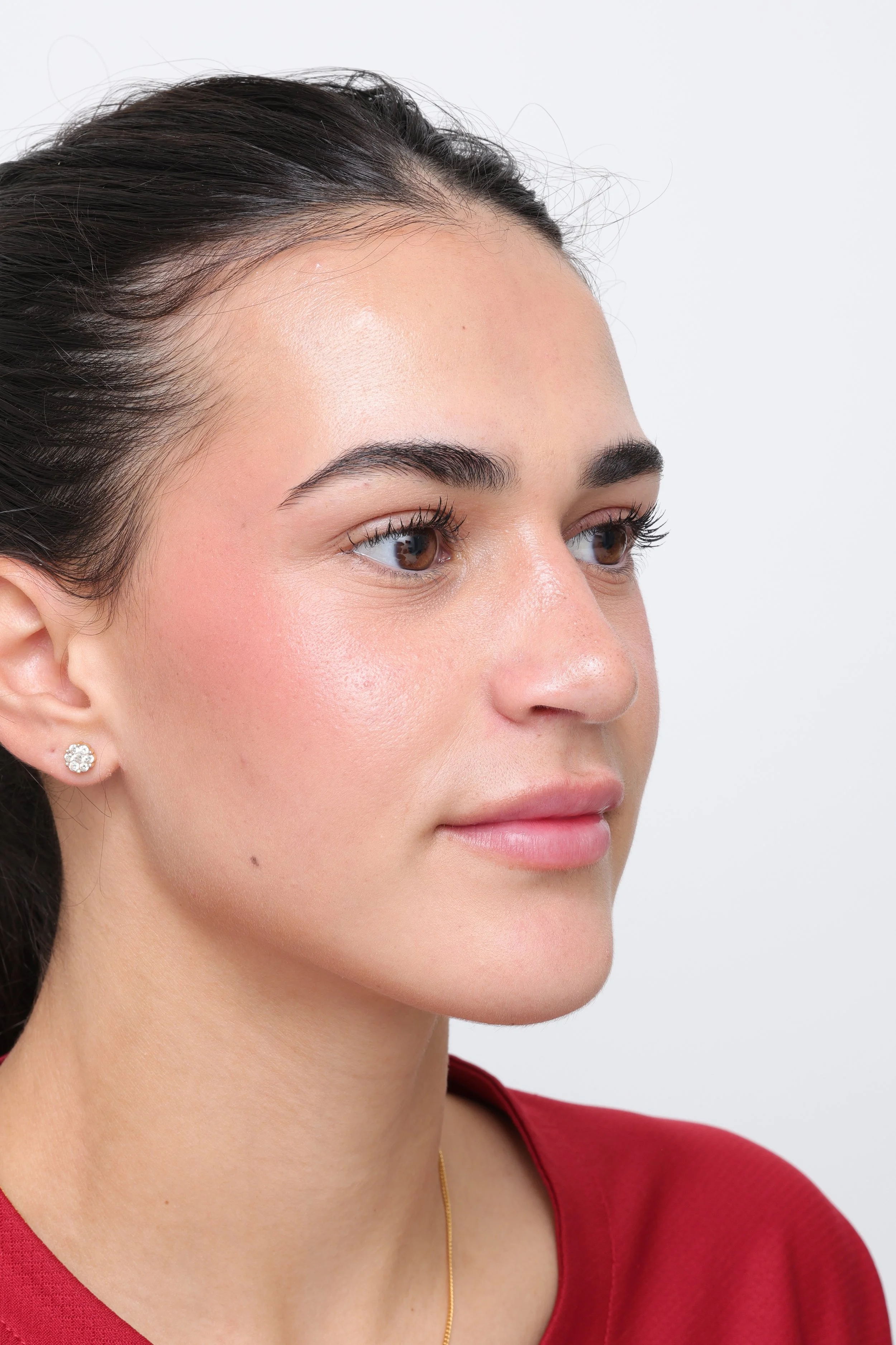 Three-quarter view three months after rhinoplasty
