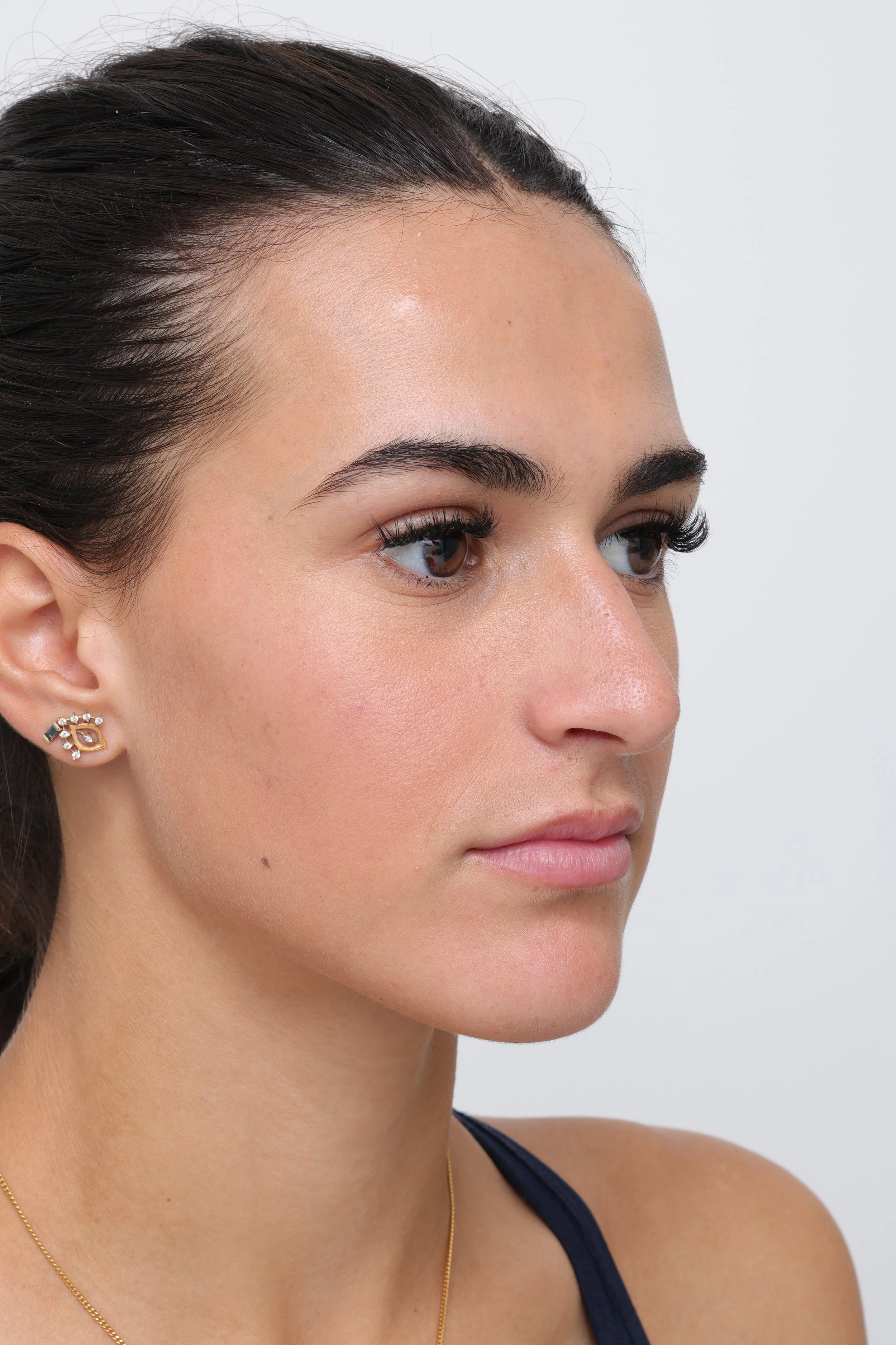 Three-quarter view before rhinoplasty