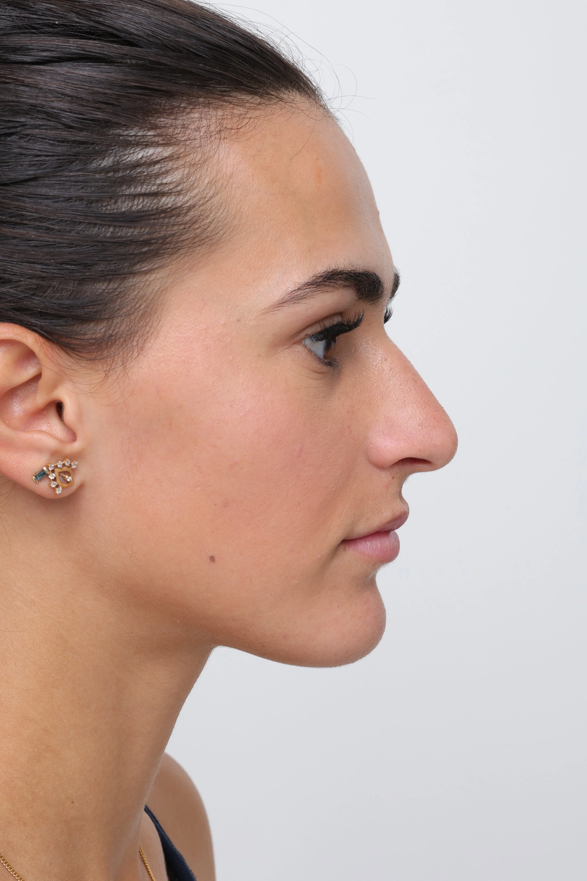 Profile view before rhinoplasty