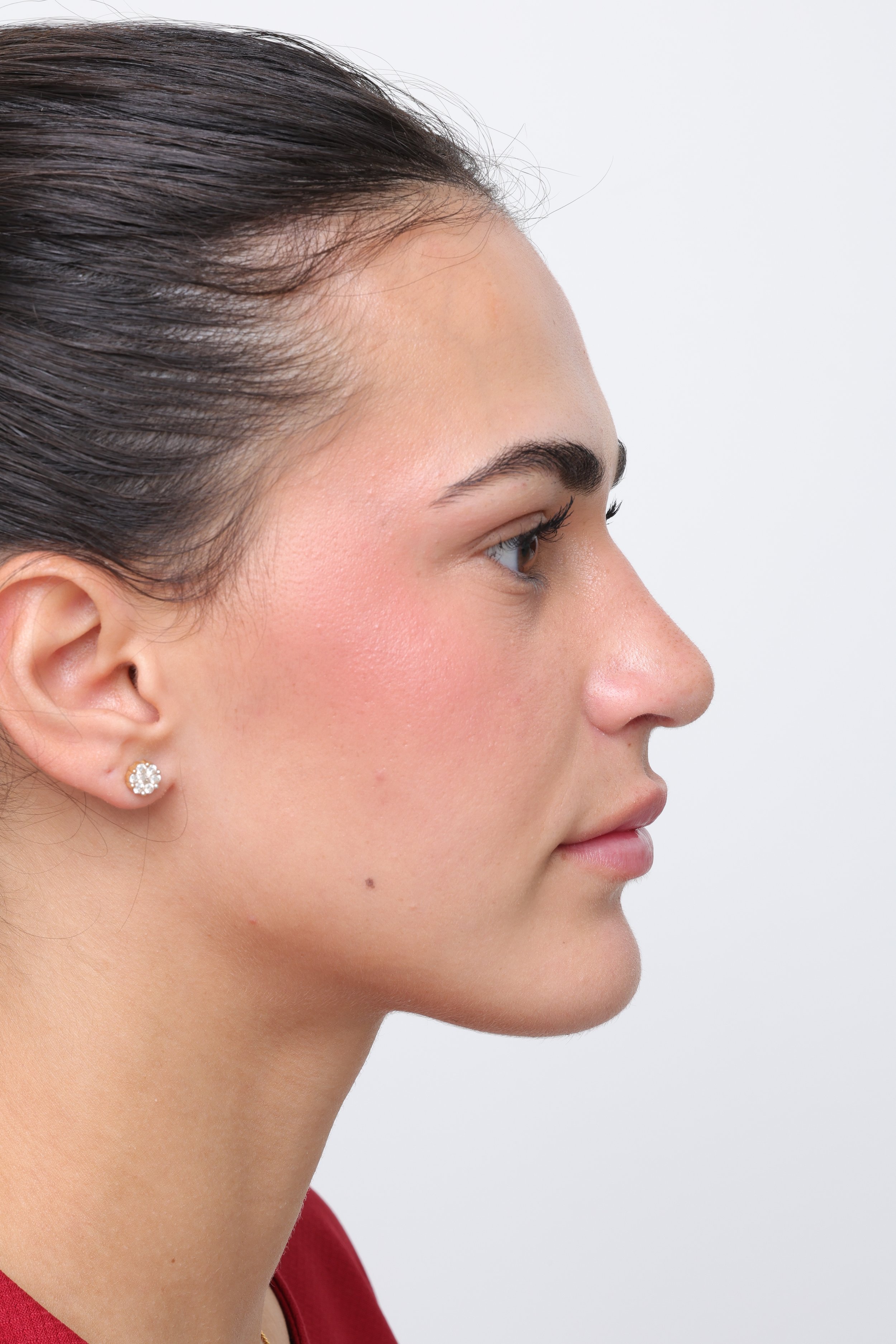 Profile view three months after rhinoplasty