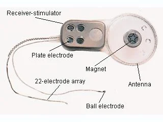 An early version of the Bionic Ear inserted under the skin