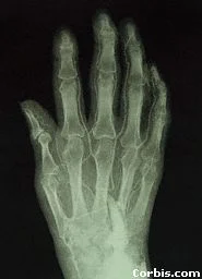 This is an X-ray of a hand. An X-ray is a photograph of the bones inside the body