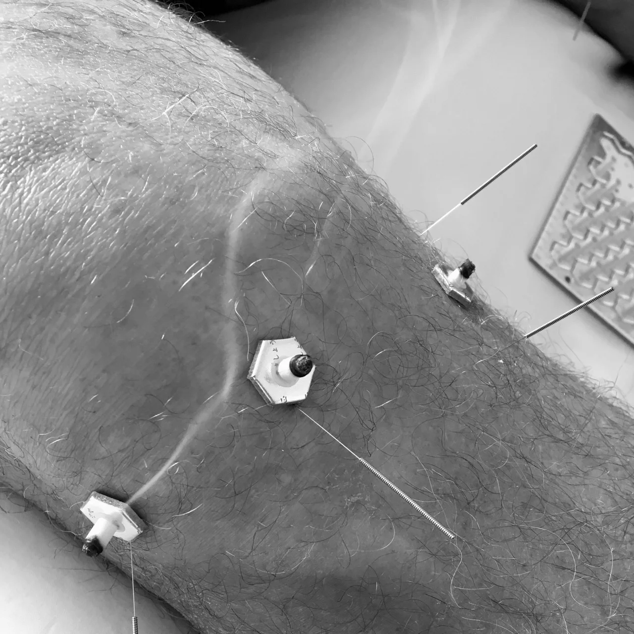 Moxa and needles on a patient’s knee