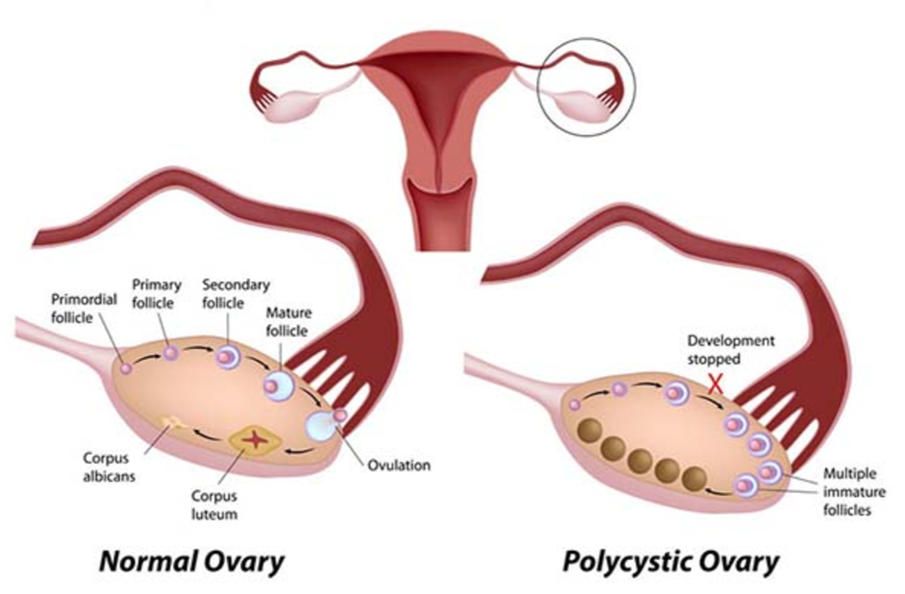 The differences between a normal ovary and infected with Polycystic Ovary Syndrome (PCOS)