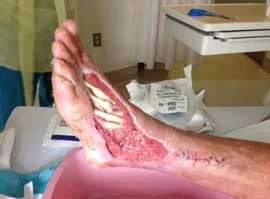 snake-bite.jpg