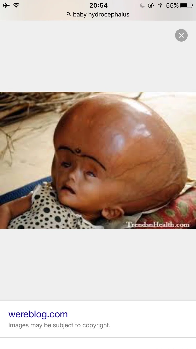 Example of hydrocephalus