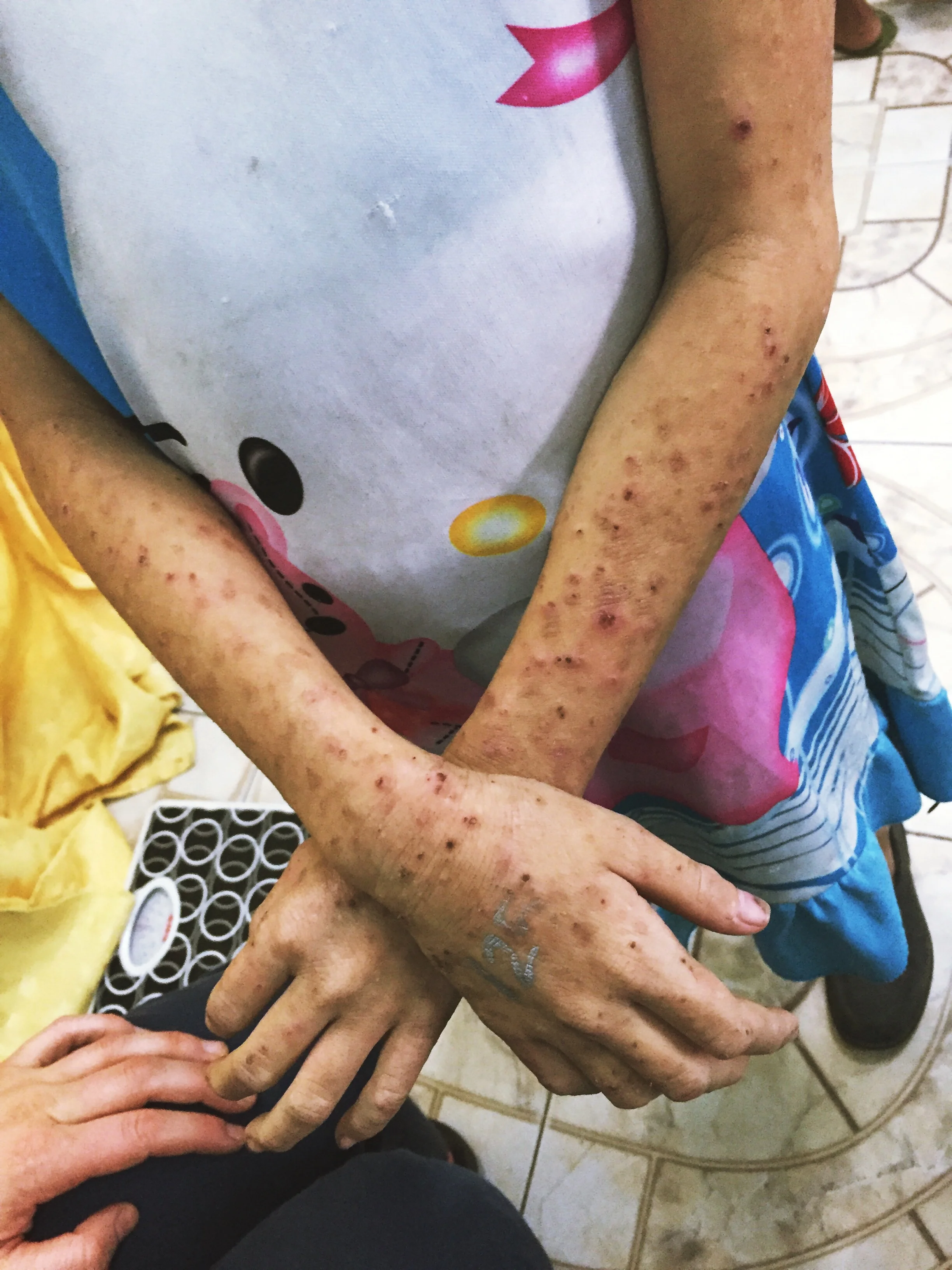 Scabies. All over her arms and legs. This is Annabelle's oldest daughter.