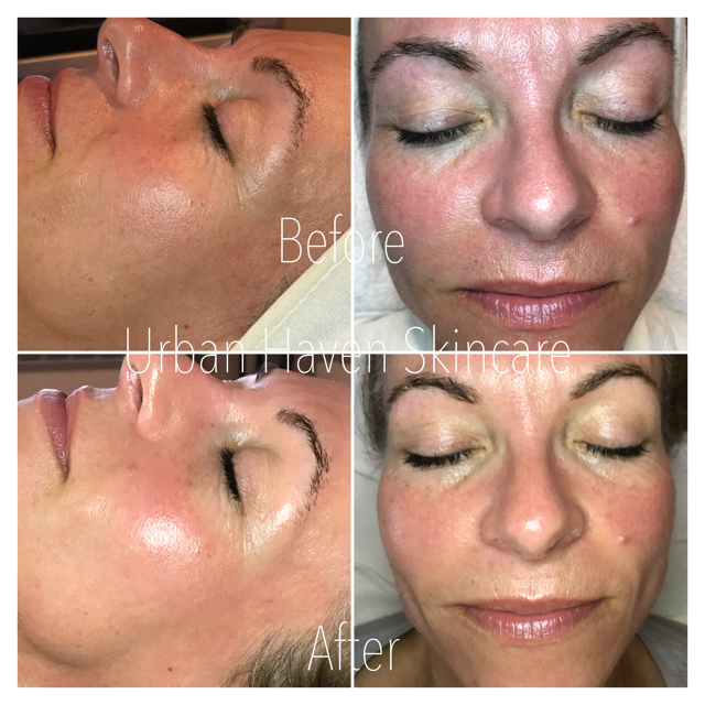 sculplla treatment near me