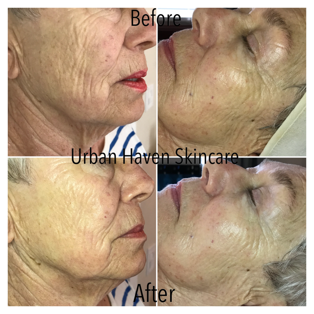 sculplla treatment near me