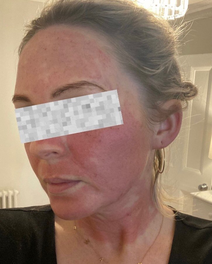 * Post- Microneedling Erythema* 

🍎 so many patients are tempted by SkinPen Precision micro needling but are worried about bleeding/redness as they see so many for for photos online. 

&bull; My lovely client sent me this patient selfie 2 hours afte