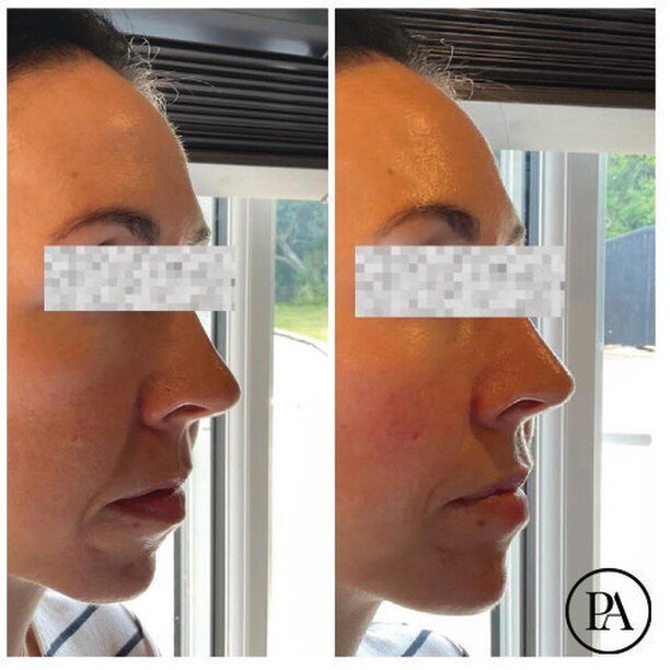 Profile balancing.

This is why a bespoke consultations with full facial analysis is so valuable. 

This lovely patient came to me complaining of dimpling chin and worsening lines around her mouth. Assessment revealed a &ldquo;weak chin&rdquo; (retro