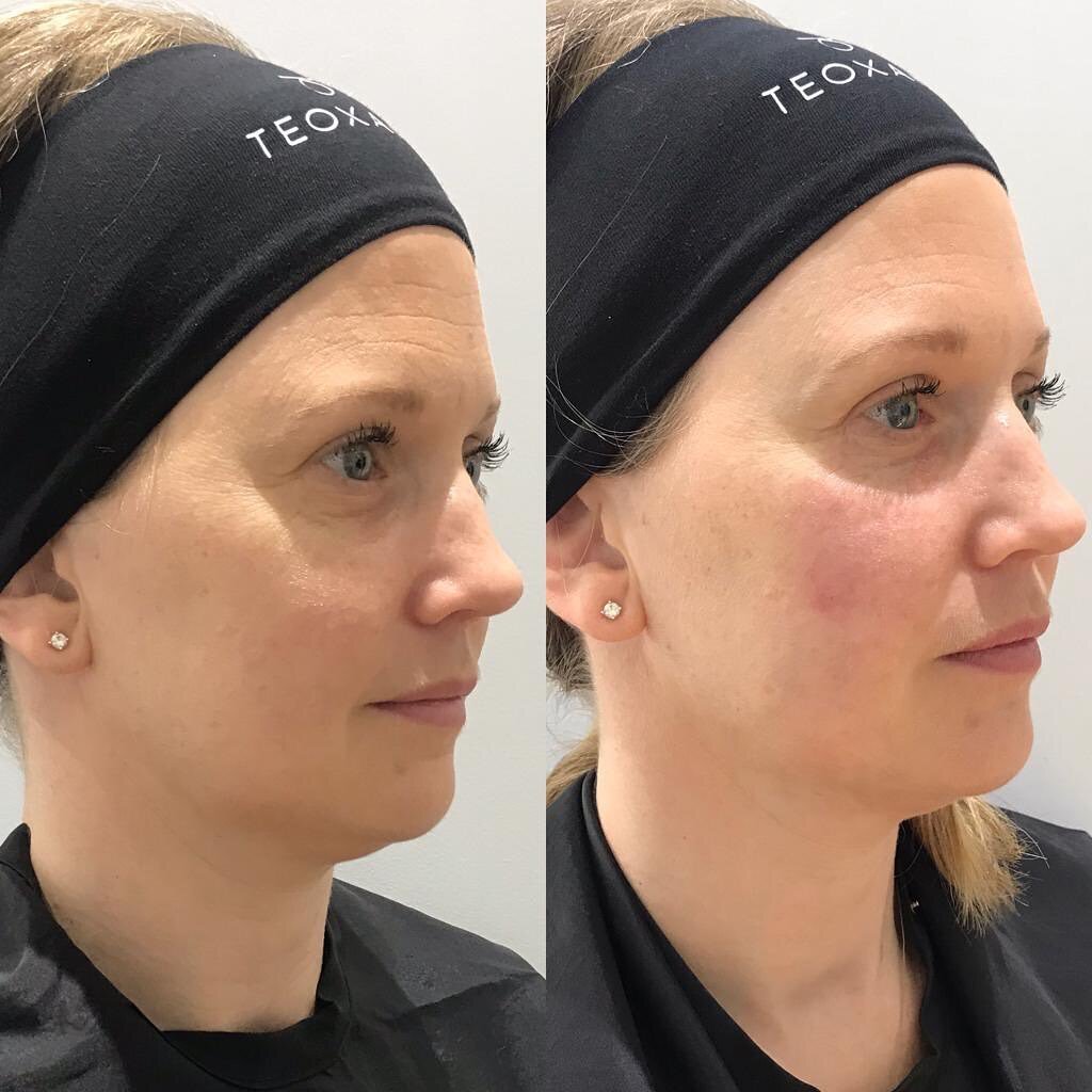 Who doesn&rsquo;t need a bit of a freshen up? 

My patients often seem surprised when I say they need some cheek fillers when they&rsquo;re actually complaining of looking tired all the time or lower face lines.

Treatment: dermal filler to midface a