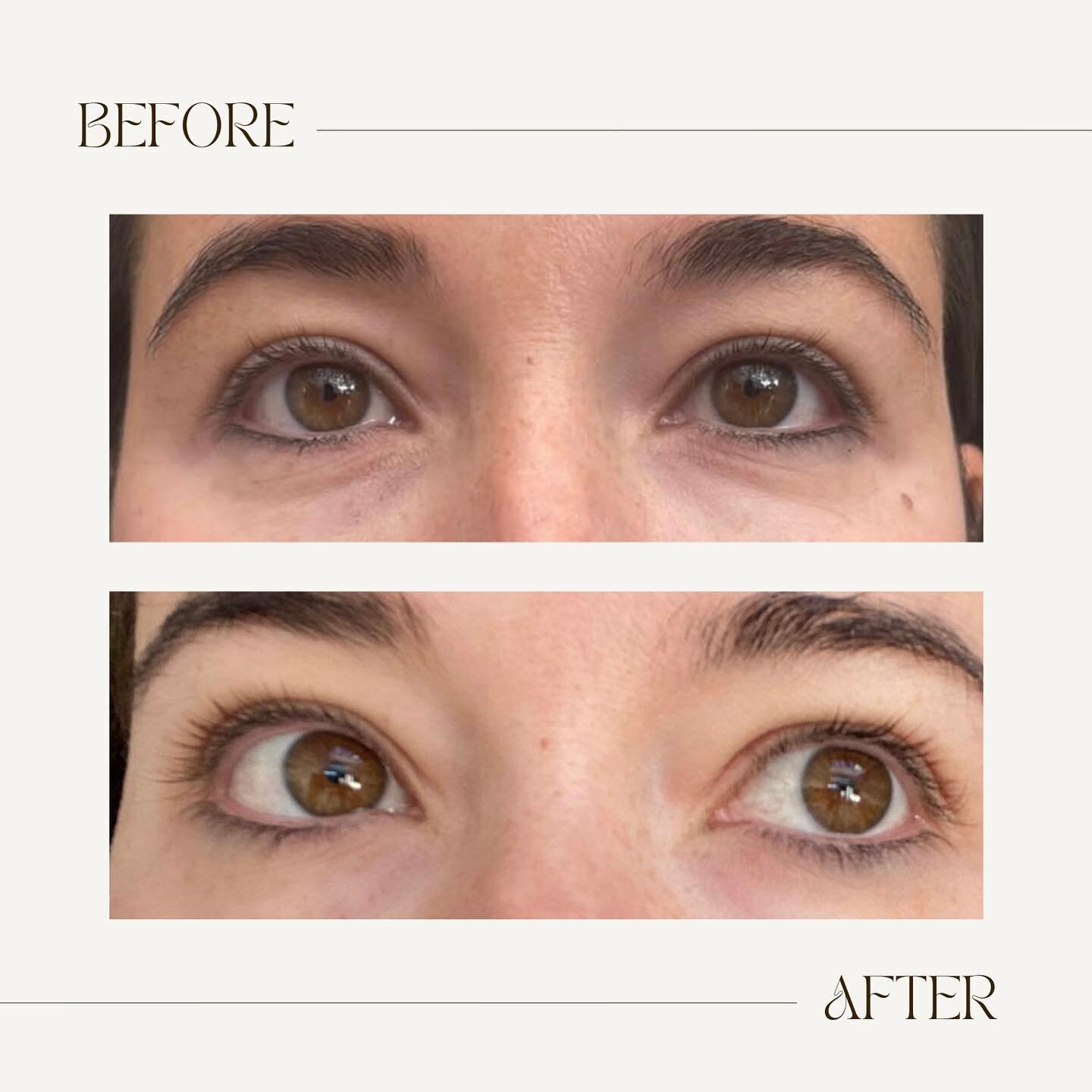 Do your eyes need a little sparkle before Christmas? Are you always searching for that eye cream that actually works? 

💉 @lighteyesultra is the treatment for you and we are so excited at Pelle aesthetics to be offering it in the clinic. This is aft