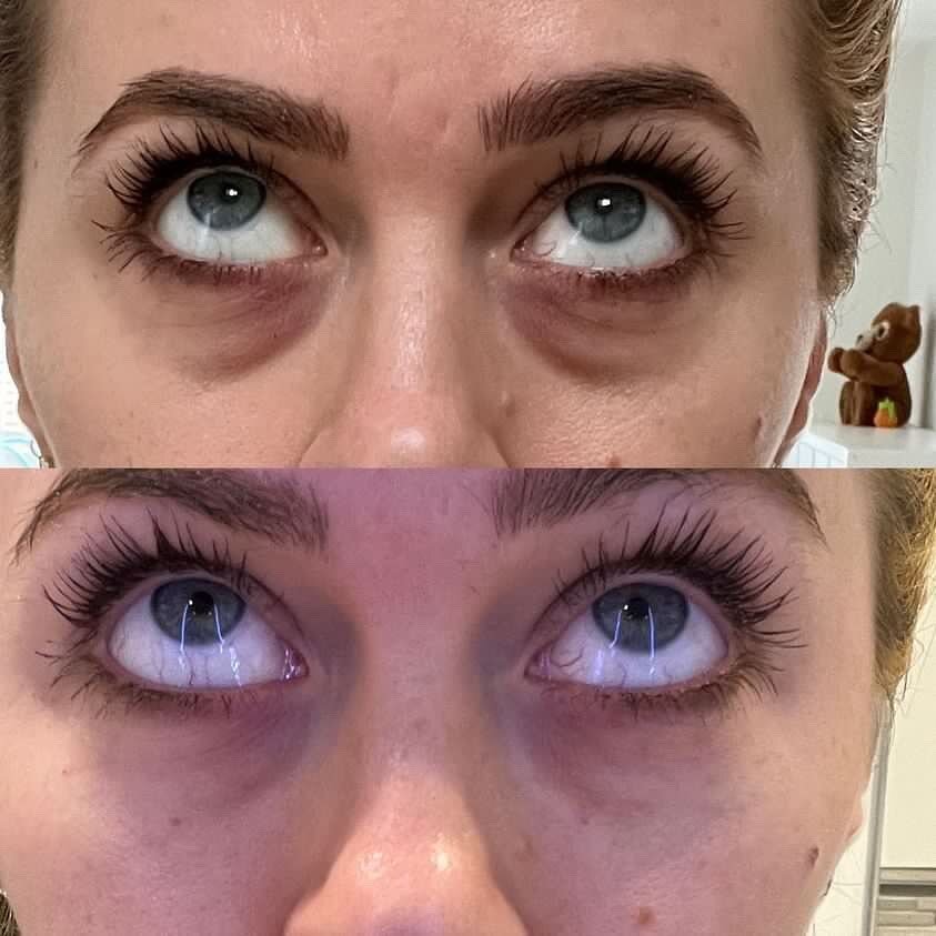 Such a difference! 

THIS is what subtle treatments that are selected based on your personal medical history, desires and risk profile can do. 

THIS is Light Eyes Ultra- an injectable treatment for the peri-ocular (around the eye) region to freshen,