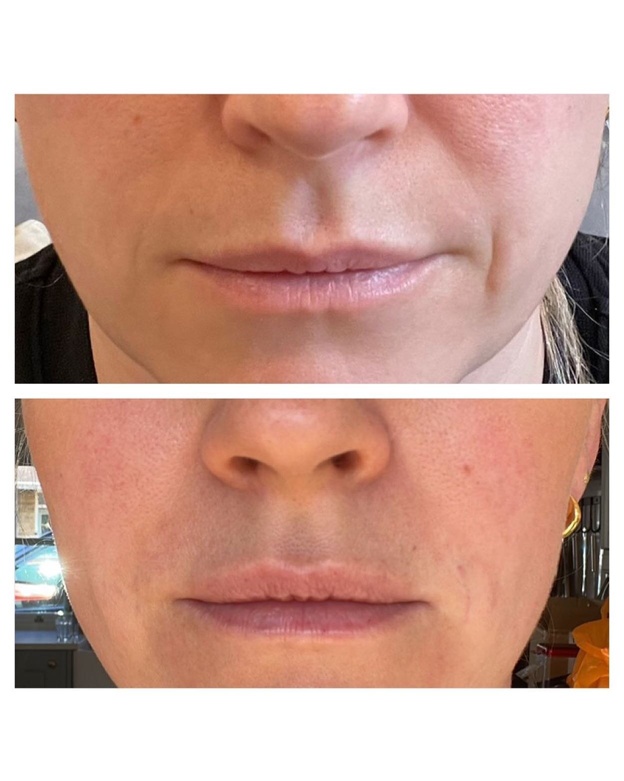 The subtle use of premium dermal fillers can give a natural but effective outcome. 

We used our favourite @teosyal fillers here to freshen up the nasolabial/marionette areas and lips. 

#lipfiller #dermalfillers #skinrejuvenation #antiageing #teoxan