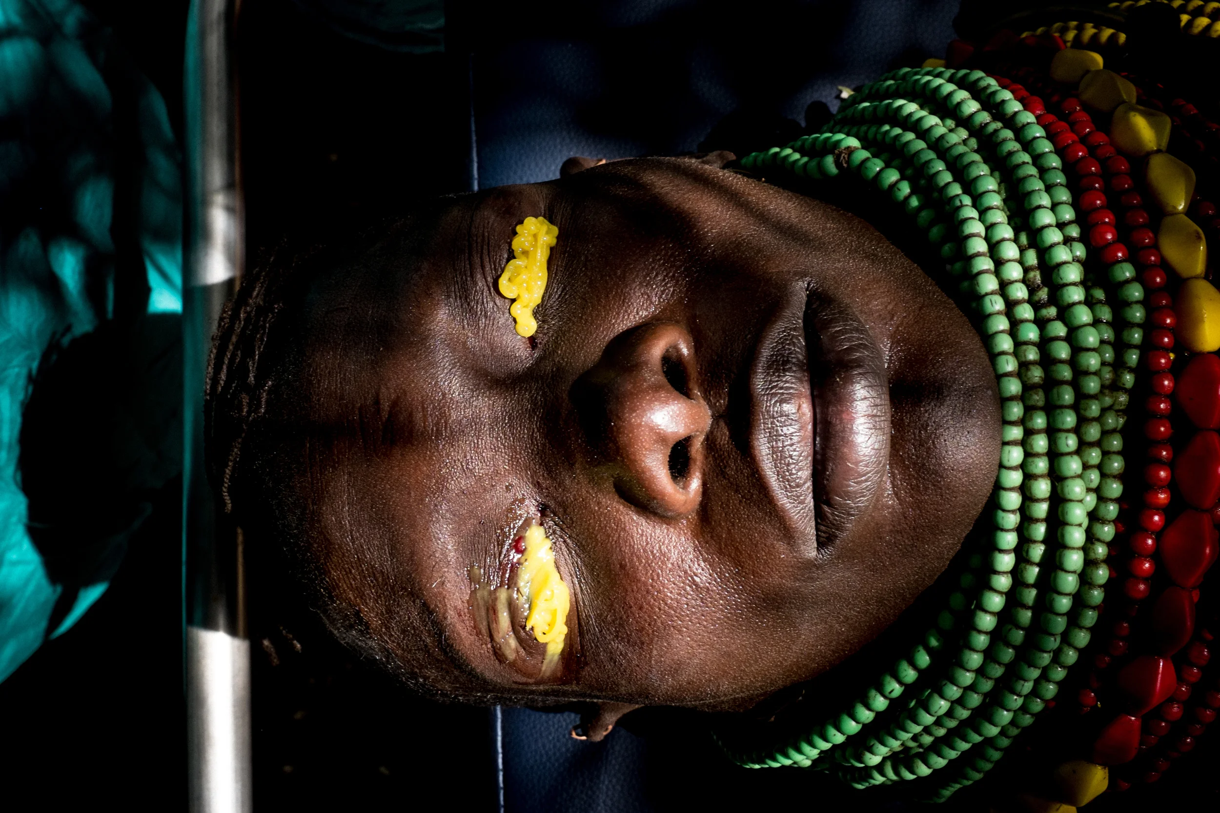  Turkana,&nbsp;Kenya for Sight Savers 