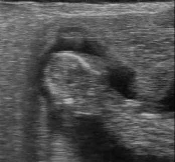 Ultrasound Image of Fetal head & part of torso