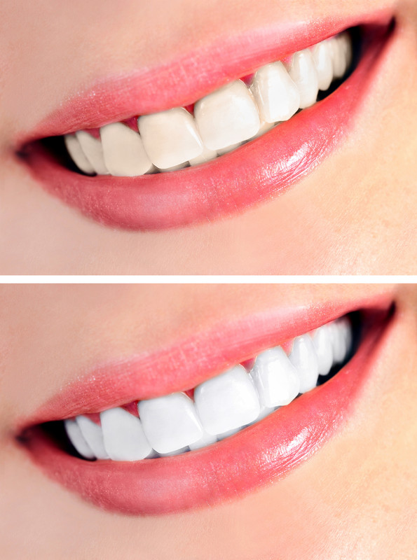A before and after comparison after teeth whitening. 