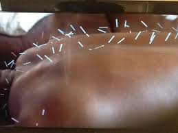 James Harrison during an acupuncture treatment often sports upwards of 200 needles.