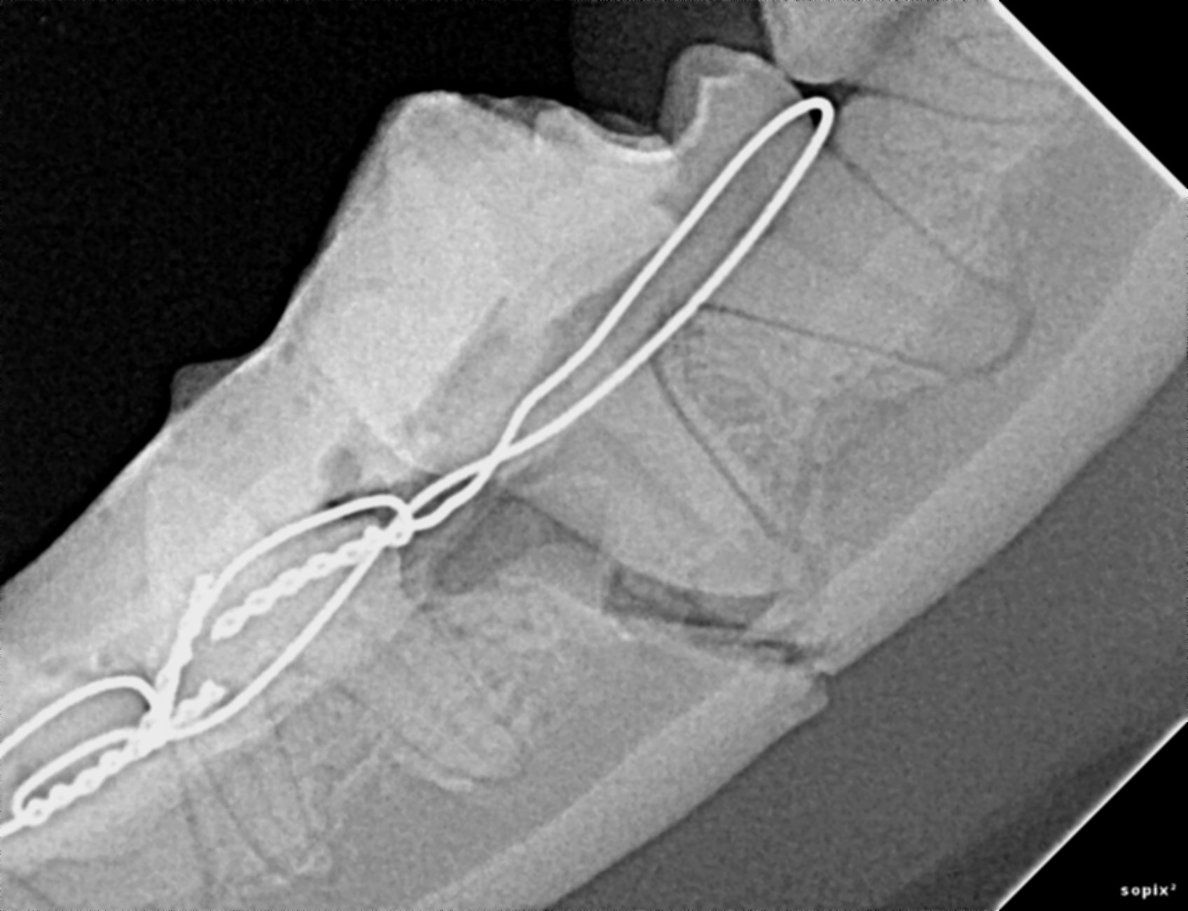 Lucille's repaired mandible