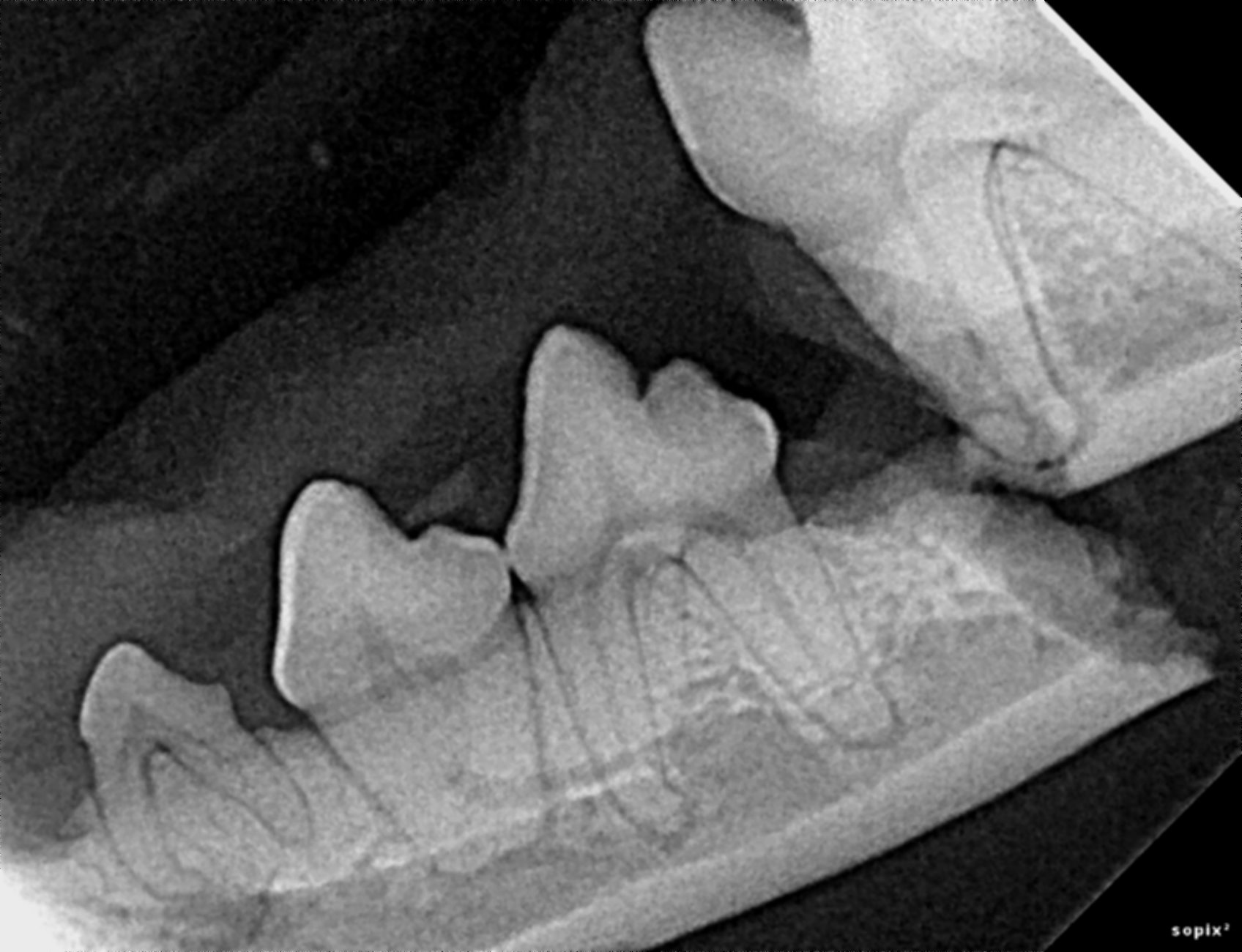 Lucille's broken mandible