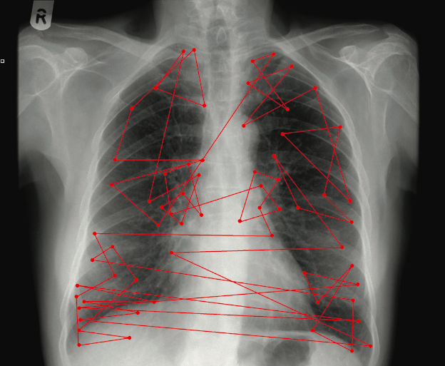 Figure 1: An example of fixations across a chest radiograph and the visual search pattern constructed by them. Image courtesy of the Ad- elaide and Meath Hospital, Dublin.&nbsp;