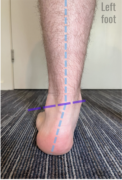 Foot Mechanics - Pronation and Supination — Rockhopper Osteopathic Clinic