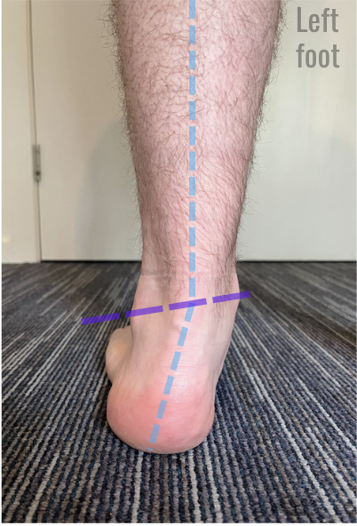 What are Pronation and Supination?