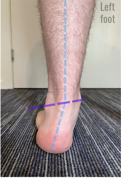 foot supination