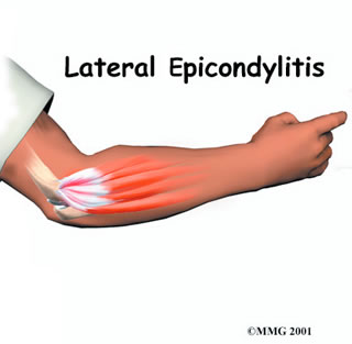 pk Verdeelstuk Smerig Elbow Tendonitis in CrossFit Athletes — Arrow Physical Therapy Seattle