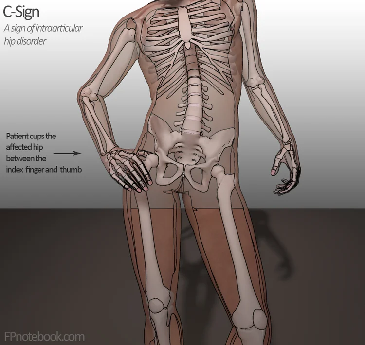 Hip Impingement And Labral Tears — Arrow Physical Therapy Seattle