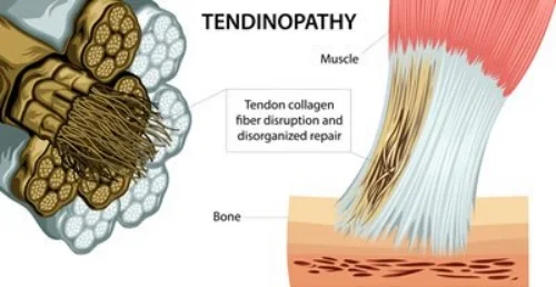 OTTEastbourne_Tendonitis_tendinosis_Fibres.jpg