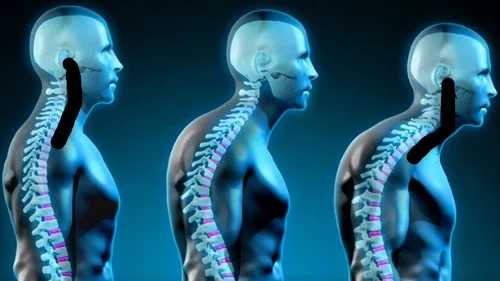 Left image demonstrate a good curve in the neck. The far right image shows a hinge area in the middle part of the neck.