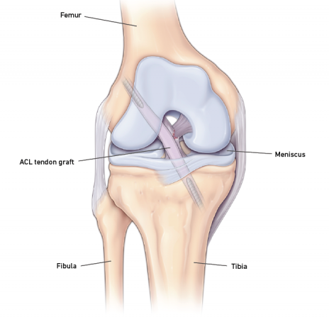Patella graph best option for acl surgery