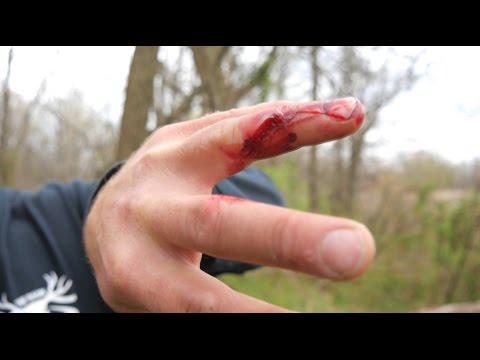 Bowhunting Turkey- A Trip to the ER
