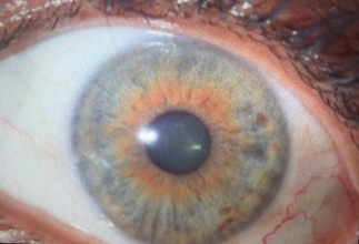 Left eye after 1 year of treatment