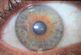 Right eye after 1 year of treatment