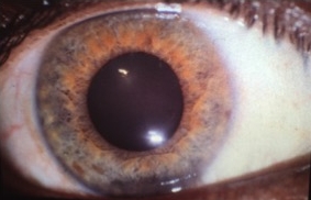 Right eye before treatment