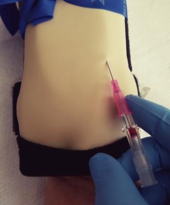 Flashback when tourniquet is on and catheter is properly inserted.