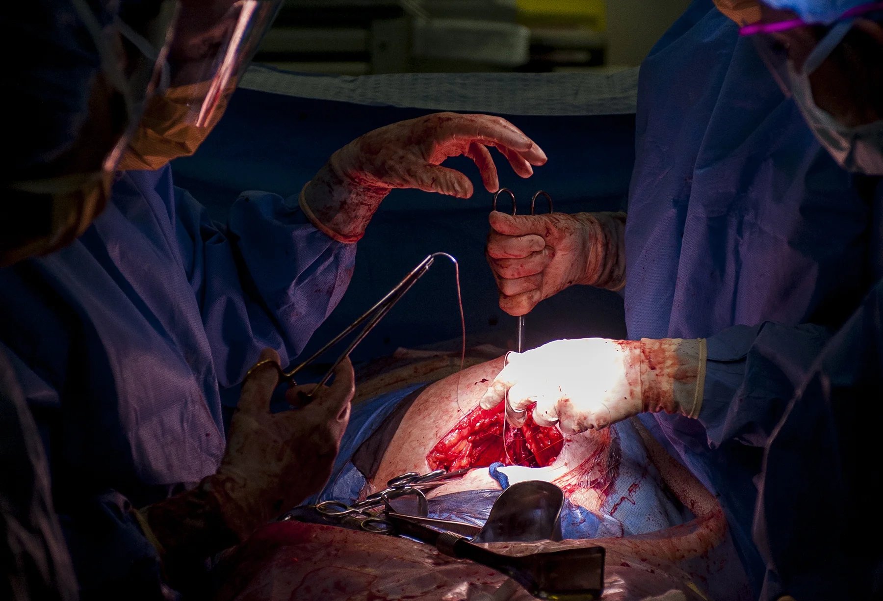  Resident Dr. Emily Burnette holds a pair of scissors in preparation to sew Semantha Smith's stomach closed after they delivered the baby boy. 