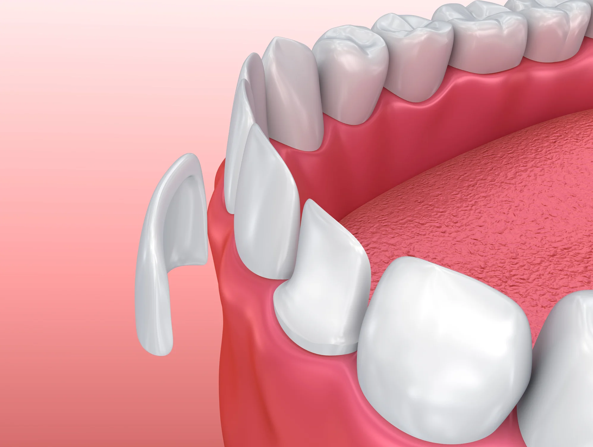 Dental veneers