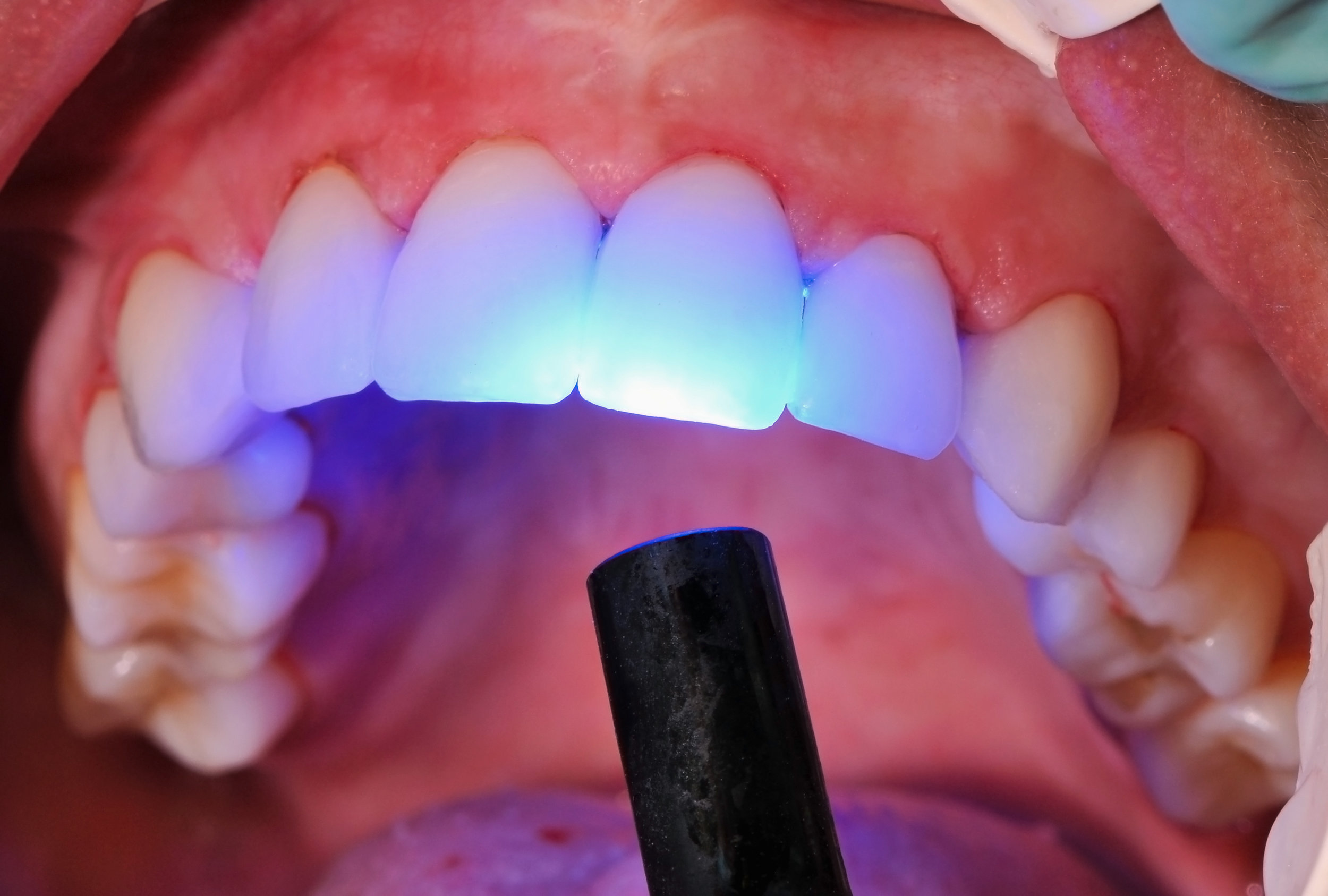 Cosmetic Bonding & Veneers