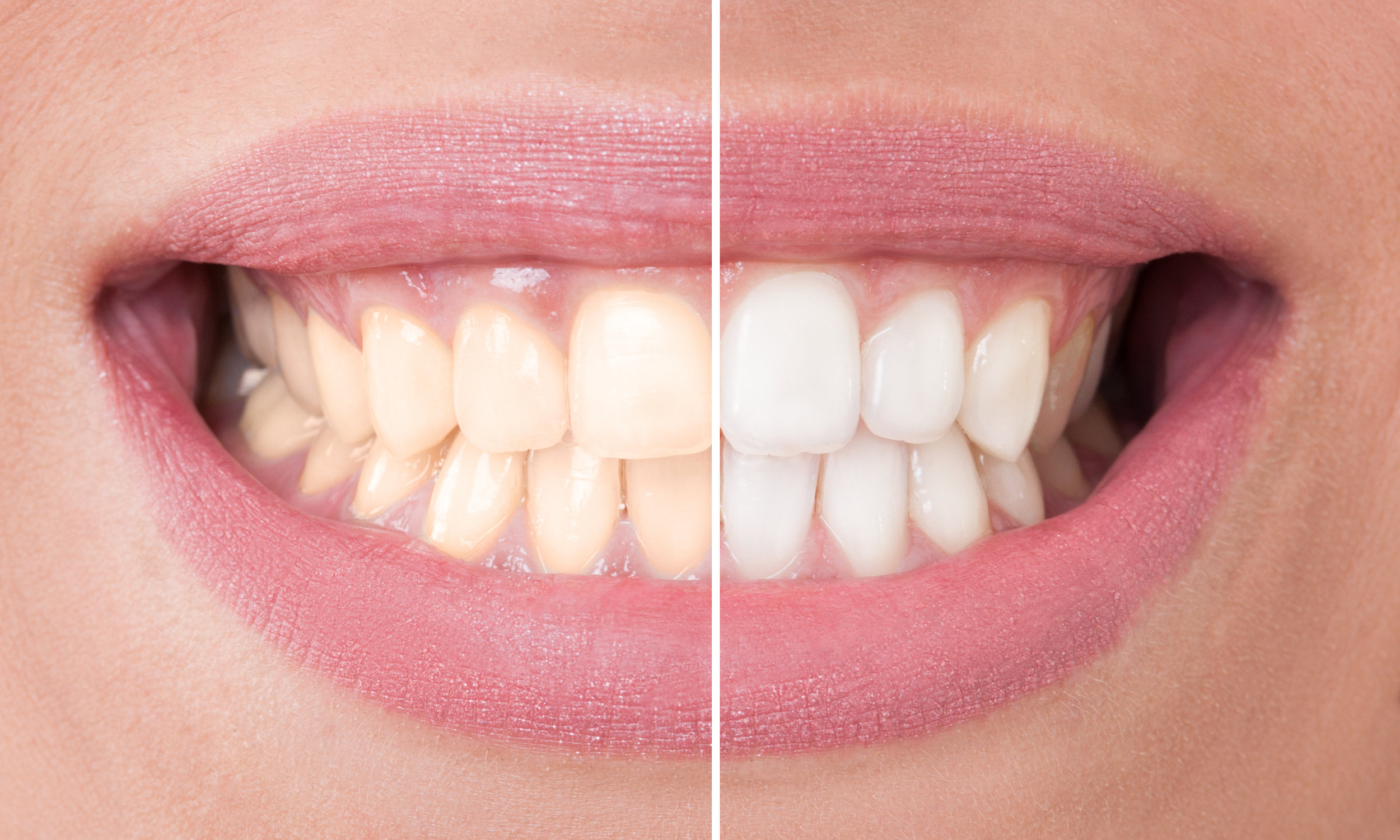 In-office bleaching 